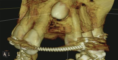 chirurgie-orale-degagement-canince-incluse__