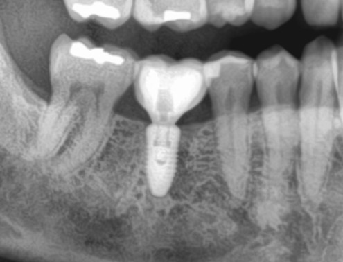 implant-taupin-cherbourg__